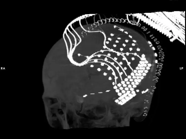 JoVE Research Video for Recording Human Electrocorticographic (ECoG) Signals for Neuroscientific Research and Real-time Functional Cortical Mapping