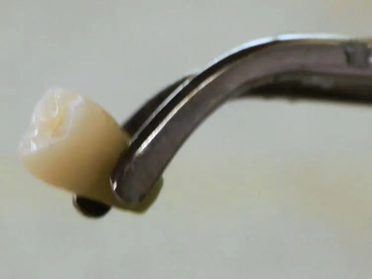JoVE Research Video for Development of Amelogenin-chitosan Hydrogel for In Vitro Enamel Regrowth with a Dense Interface