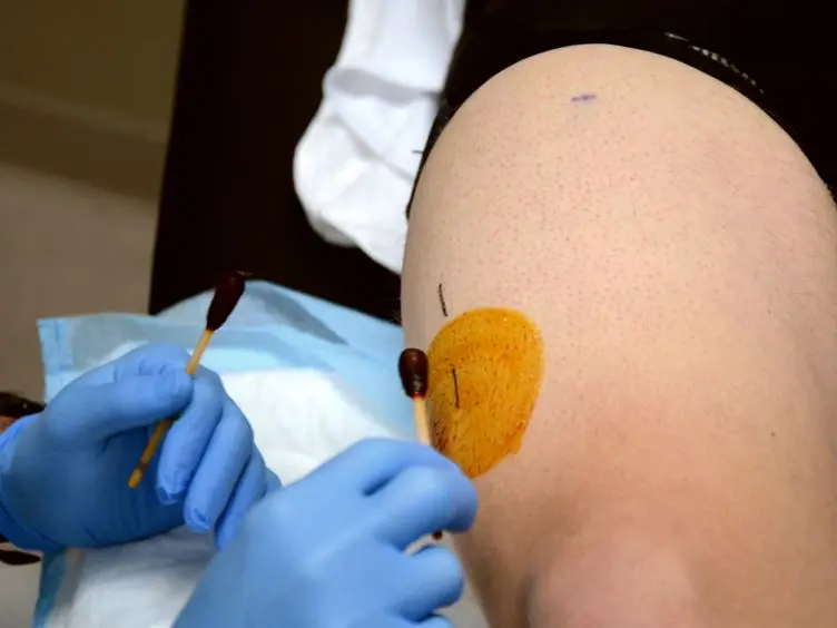 JoVE Research Video for Human Skeletal Muscle Biopsy Procedures Using the Modified Bergström Technique