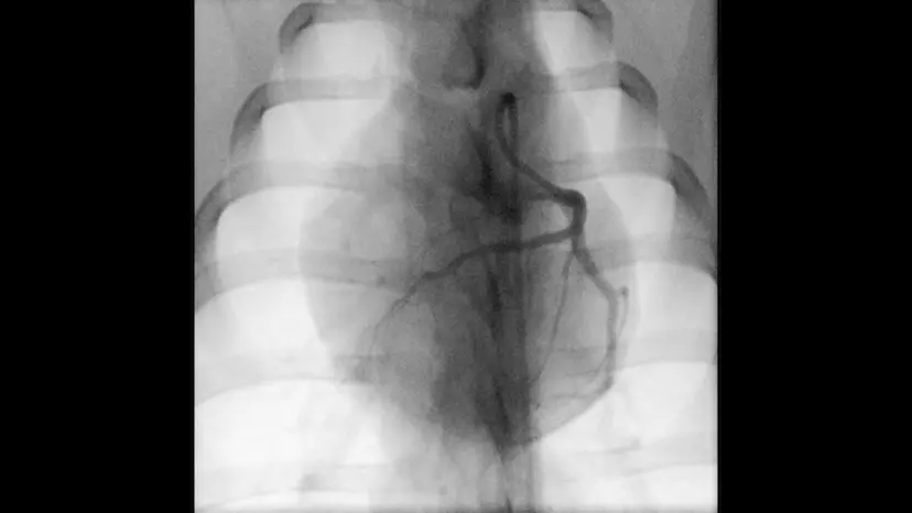 JoVE Research Video for Post-Myocardial Infarction Heart Failure in Closed-chest Coronary Occlusion/Reperfusion Model in Göttingen Minipigs and Landrace Pigs