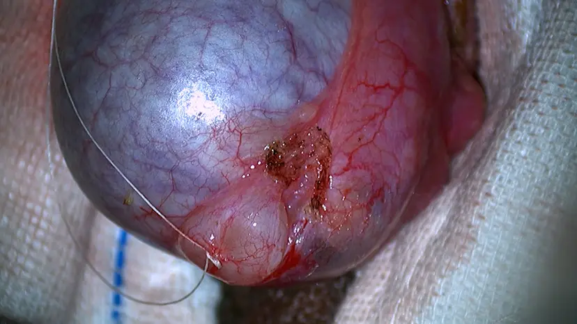 JoVE Research Video for Microscopic Cyst Resection for the Treatment of Patients Diagnosed with Epididymal Cyst