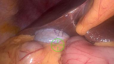 Application of Robot-assisted Pancreaticobiliary Junction Resection in Benign Duodenal Tumors