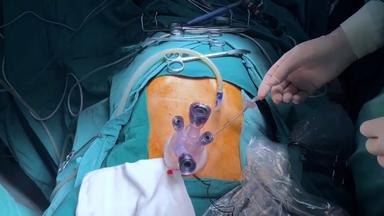 Single Incision Plus One Port Laparoscopic Proximal Gastrectomy with Double Channel Anastomosis for Gastric Cancer Treatment