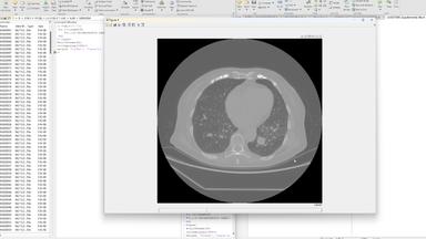 Multifractal Spectrum Analysis for Assessing Pulmonary Nodule Malignancy