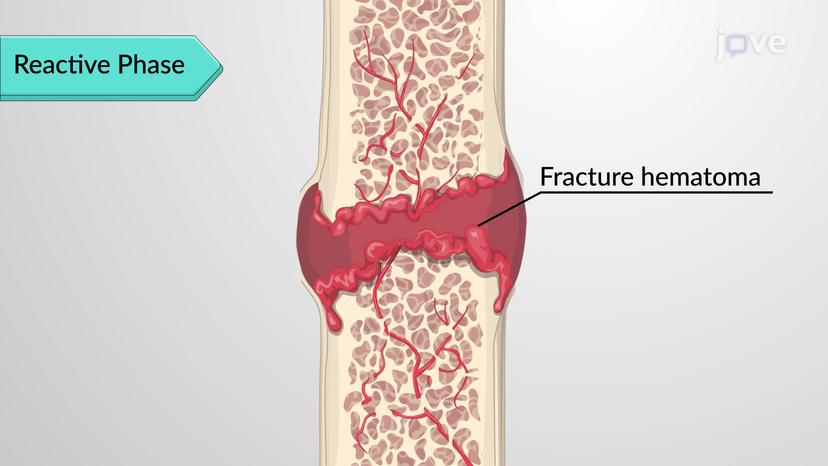 Fractures: Bone Repair