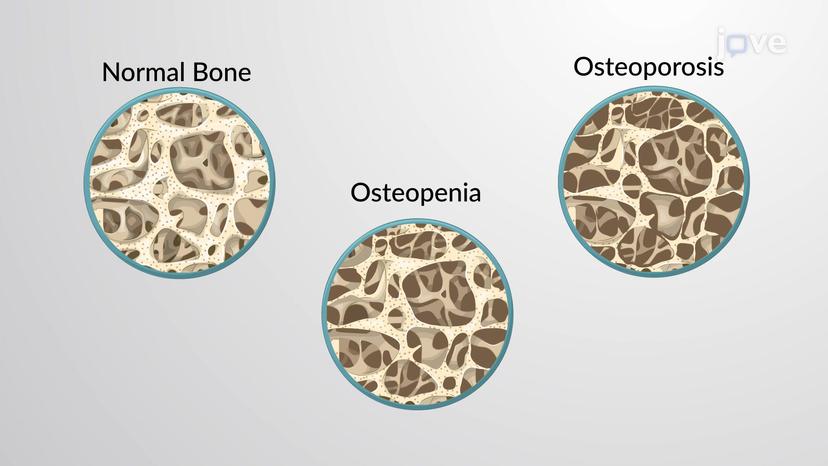 Bone Disorders