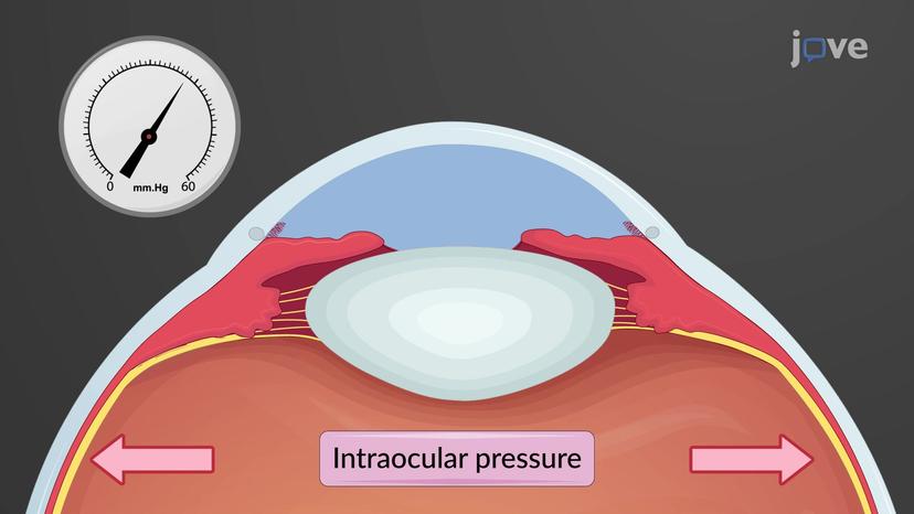 Glaucoma: Overview