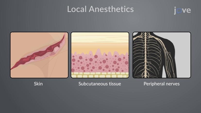 Local Anesthetics: Clinical Application as Surface, Infiltration, and Conduction Block Anesthesia