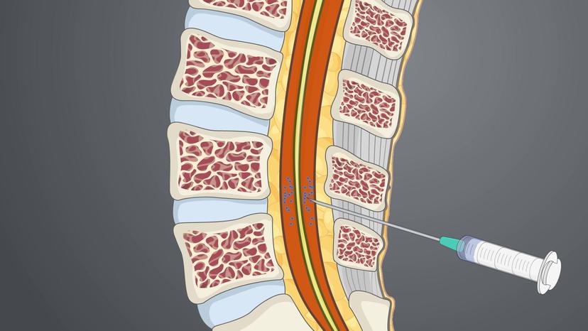 Local Anesthetics: Clinical Application as Spinal Anesthesia