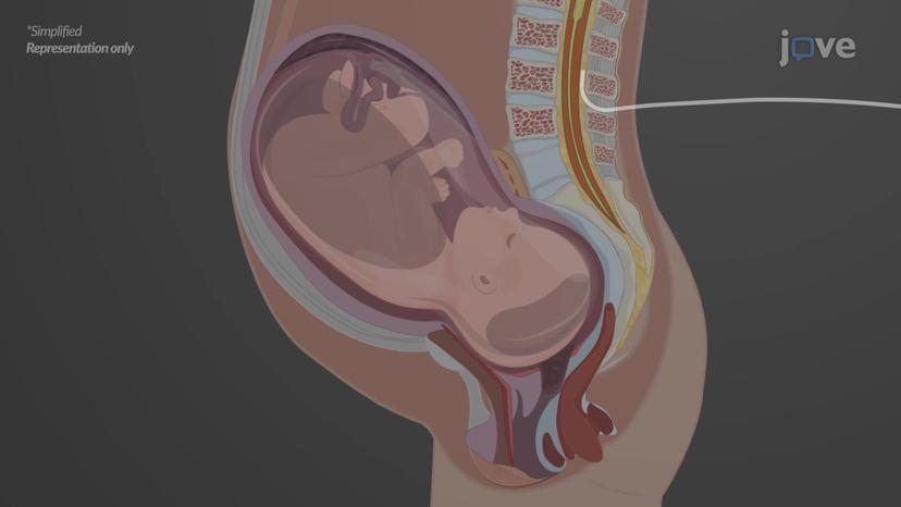 Local Anesthetics: Clinical Application as Epidural Anesthesia