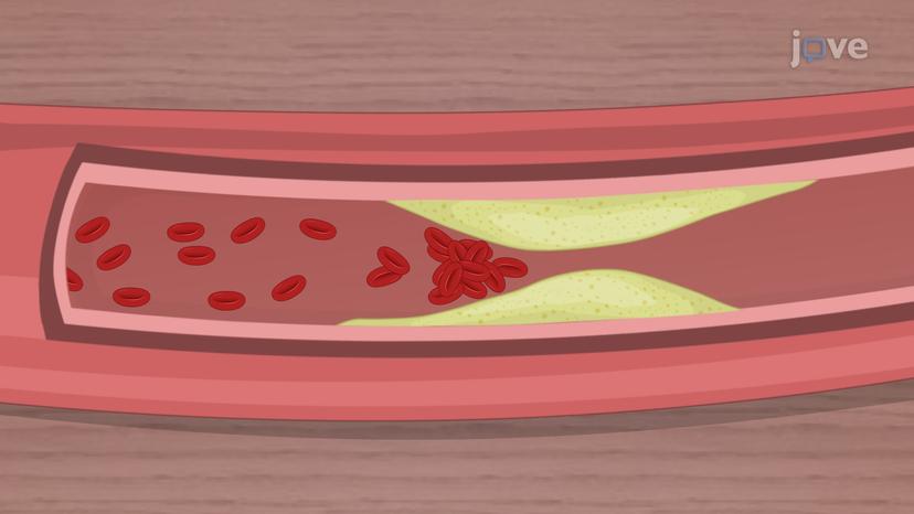 Ischemic Heart Disease: Overview