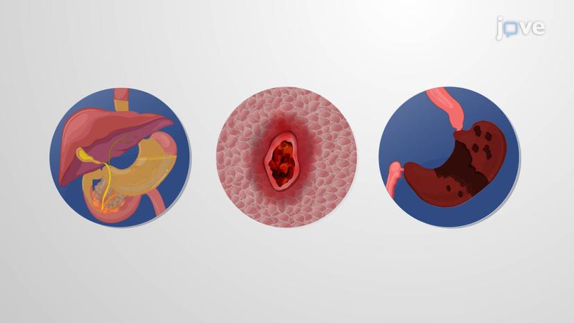 Pathophysiology of Peptic Ulcer Disease: Mucosal Defense Factors