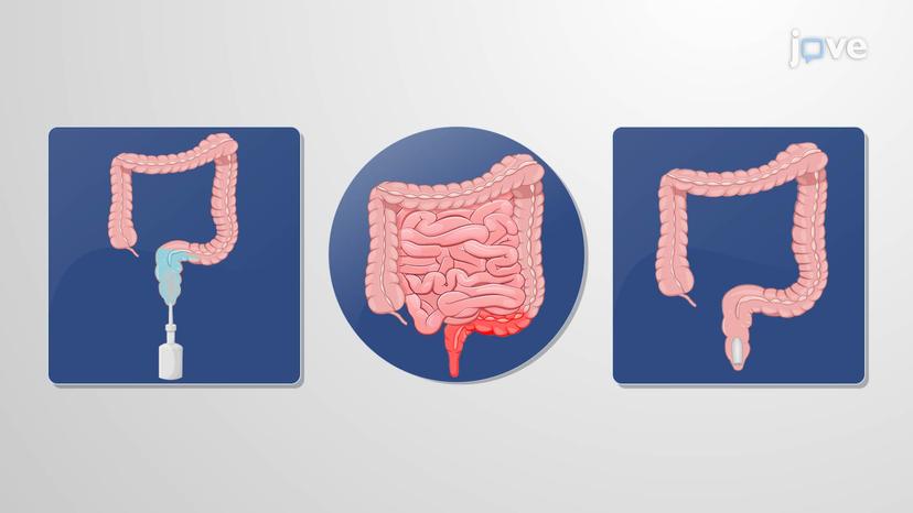 Drugs for Treatment of Crohn's Disease in IBD Using Glucocorticoids