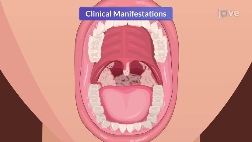 Acute Pharyngitis