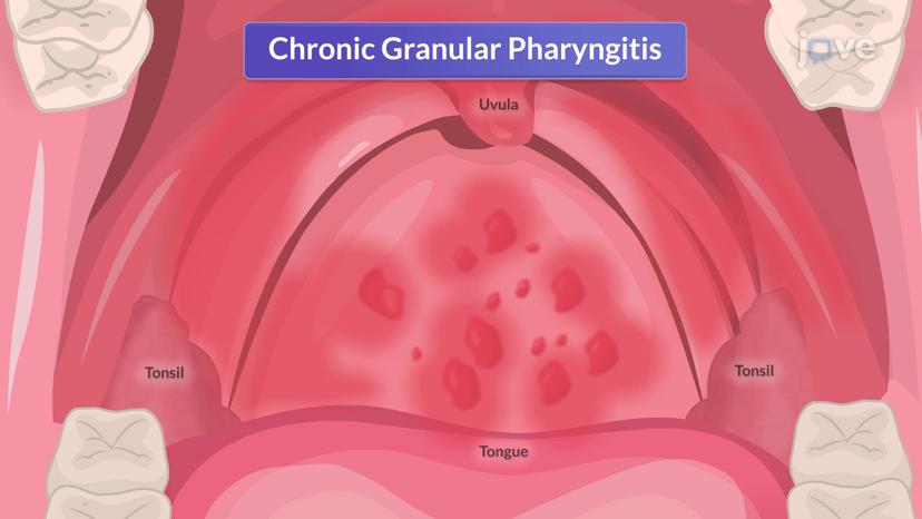 Chronic Pharyngitis