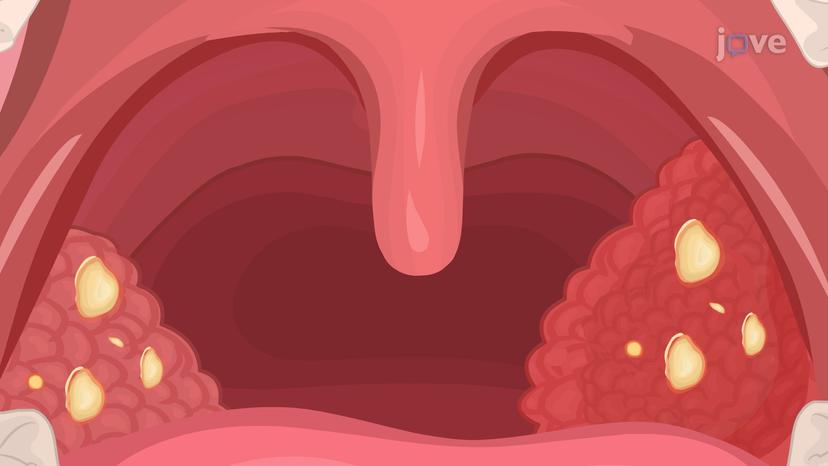 Tonsillitis I: Introduction