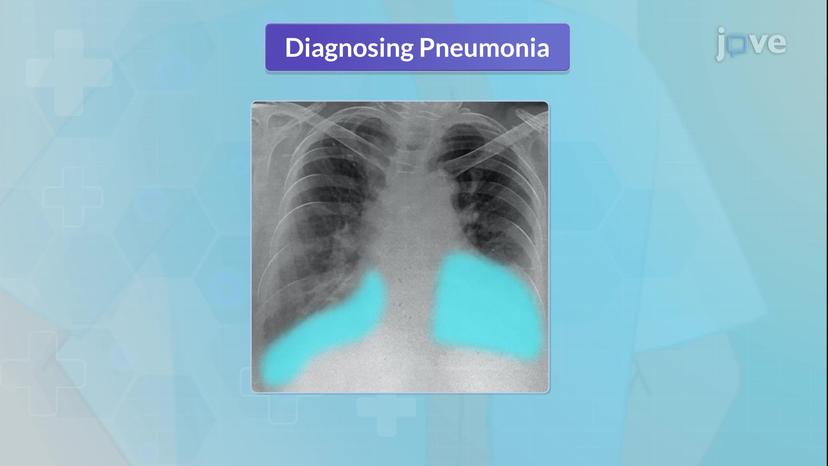 Pneumonia III: Complications and Assessment