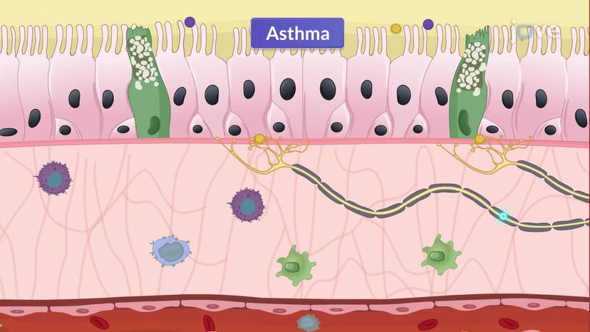 Asthma-II: Pathophysiology and Classification