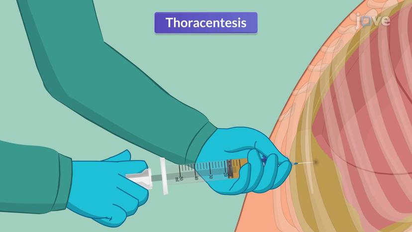 Endoscopic Studies II: Thoracocentesis