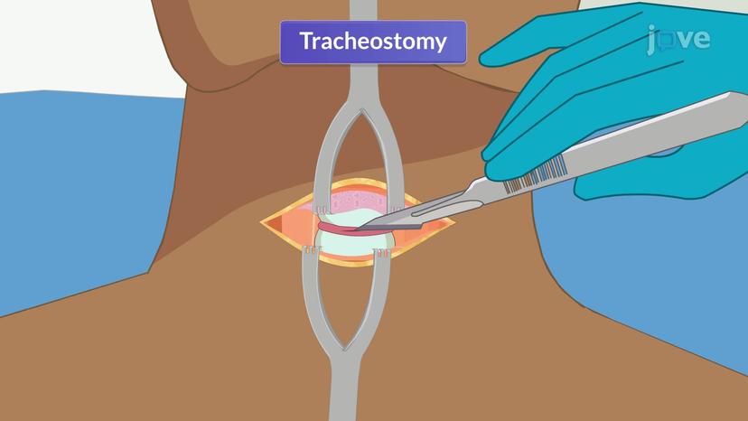 Oxygen Delivering System III: Tracheostomy and T-piece