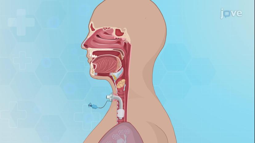 Tracheostomy: Procedure and Tubes