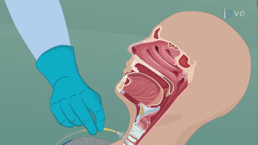 Tracheostomy Suctioning I: Pre-Procedural Steps