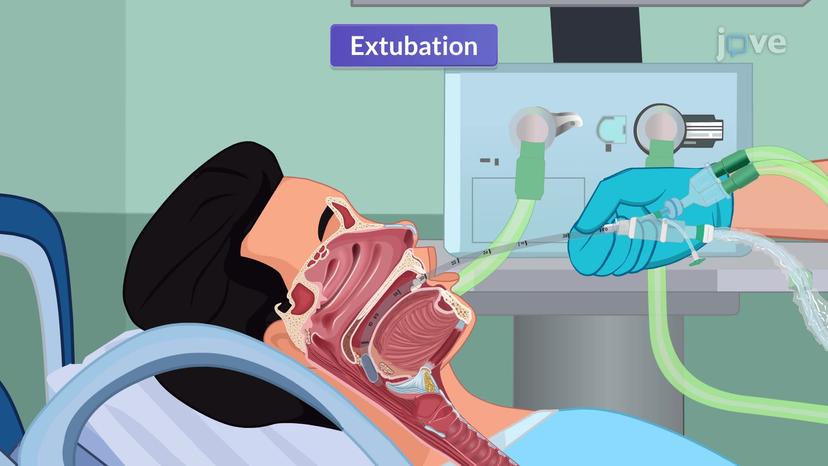 Endotracheal Tube Extubation