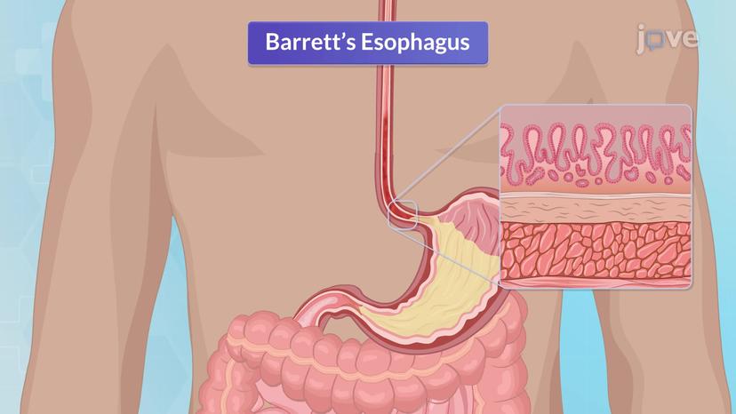 Barrett Esophagus-I: Introduction