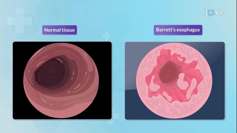 Barrett Esophagus-II: Clinical Manifestations and Management