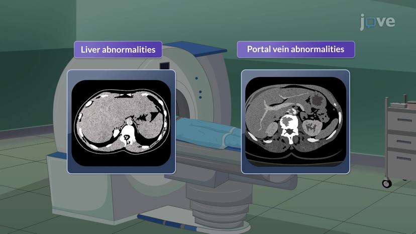 Esophageal Varices-II: Clinical Features and Management