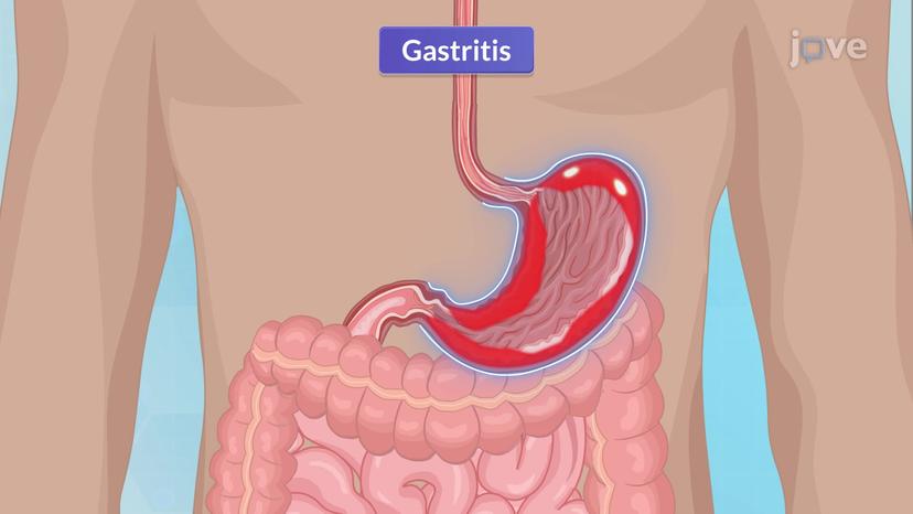 Gastritis-I: Introduction and Types