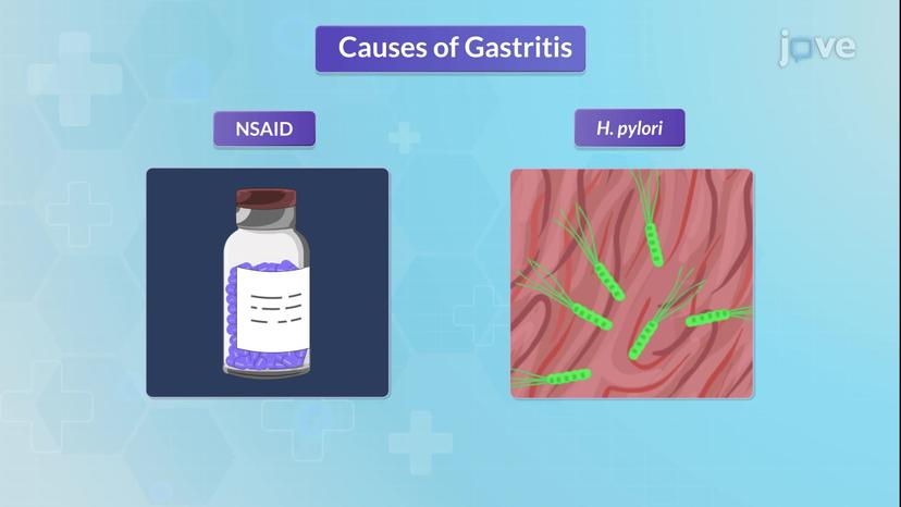 Gastritis-II: Pathophysiology