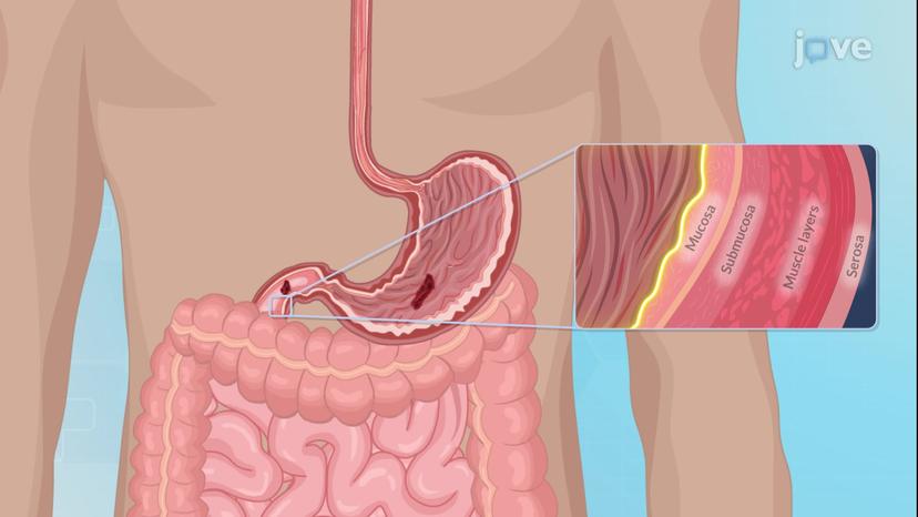 Peptic Ulcer Disease II: Pathophysiology