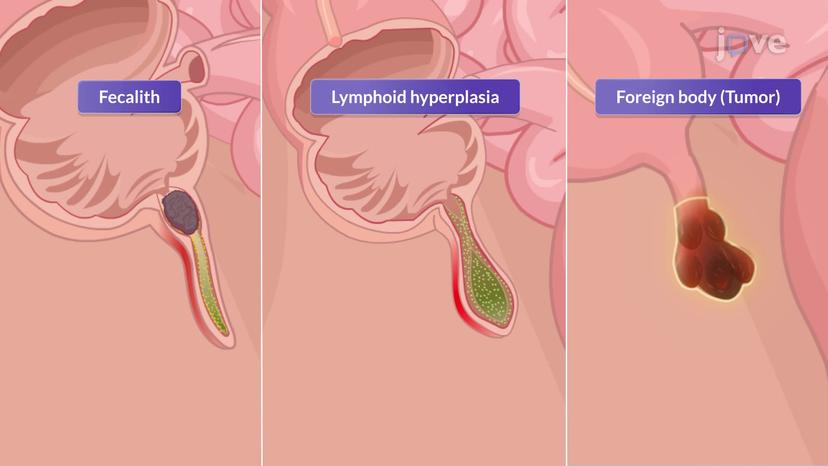 Appendicitis-I: Introduction