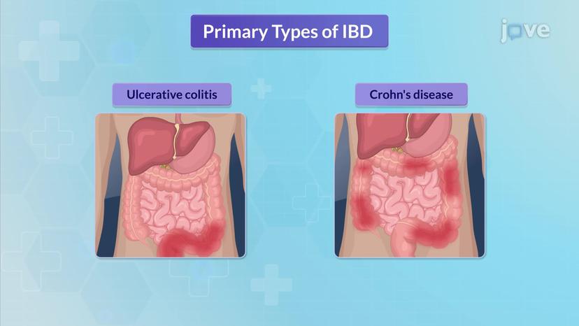 Inflammatory Bowel Disease I: Ulcerative Colitis