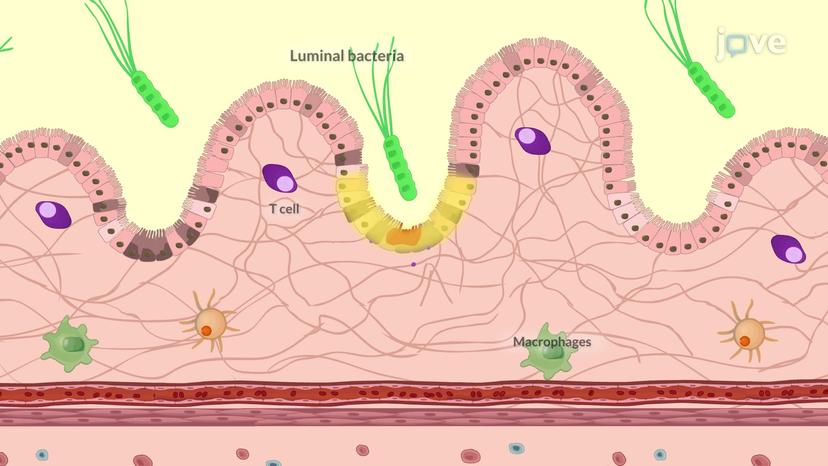 Inflammatory Bowel Disease II: Crohn's Disease