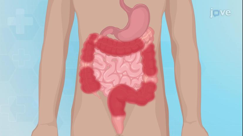 Inflammatory Bowel Disease  V: Surgical Management