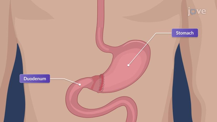 Peptic Ulcer Disease V: Surgical Management and Nursing Care