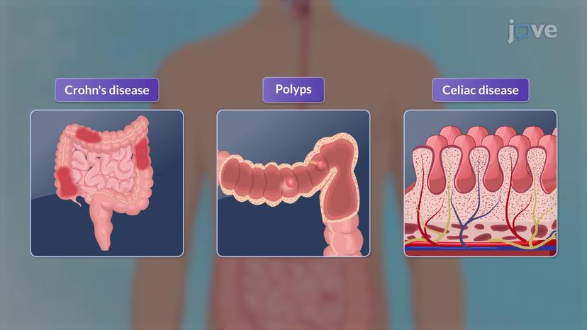 Endoscopic Procedures III: Video Capsule Endoscopy