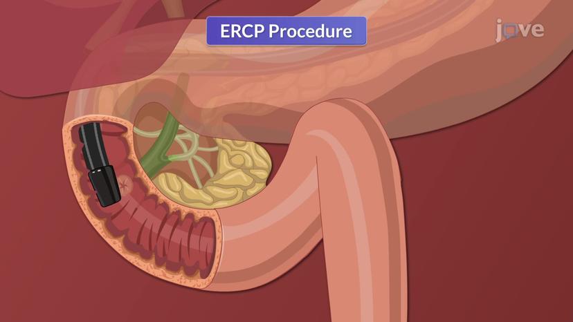 Endoscopic Procedures V: ERCP