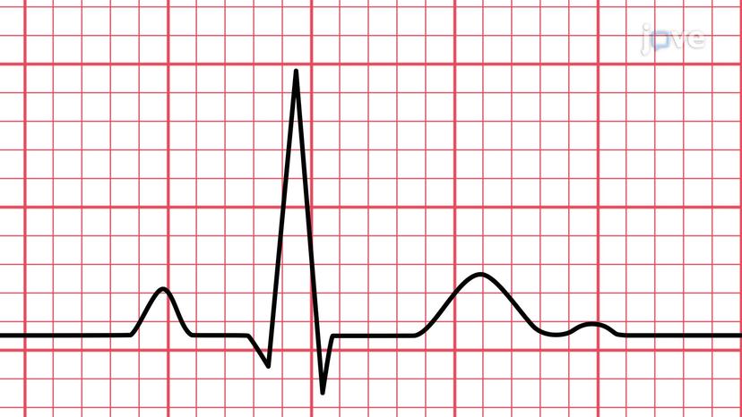 ECG Interpretation of Rhythms