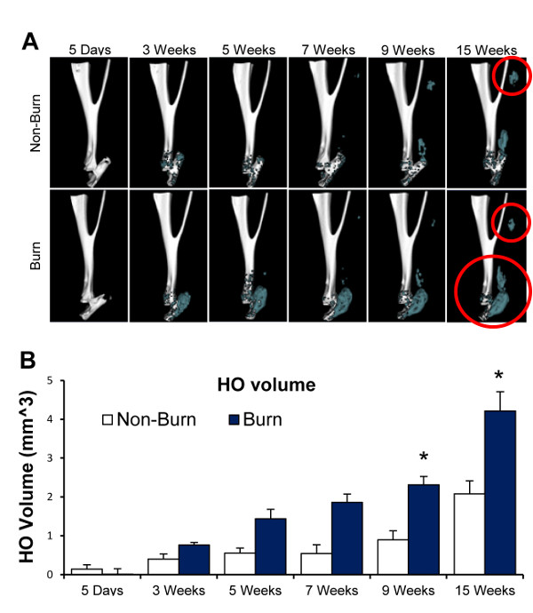 Achilles on sale tendon burns