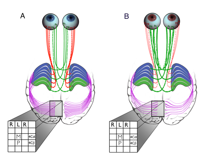 Measuring Connectivity in the Primary Visual Pathway in Human Albinism  Using Diffusion Tensor Imaging and Tractography