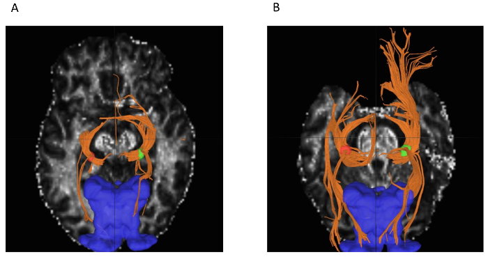 Measuring Connectivity in the Primary Visual Pathway in Human Albinism  Using Diffusion Tensor Imaging and Tractography