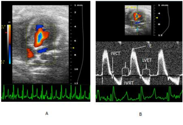 eco doppler per stenosi aortica