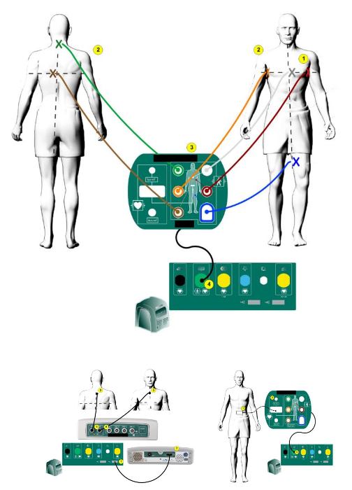 Ablation of Ischemic Ventricular Tachycardia Using a Multipolar Catheter  and 3-dimensional Mapping System for High-density Electro-anatomical  Reconstruction