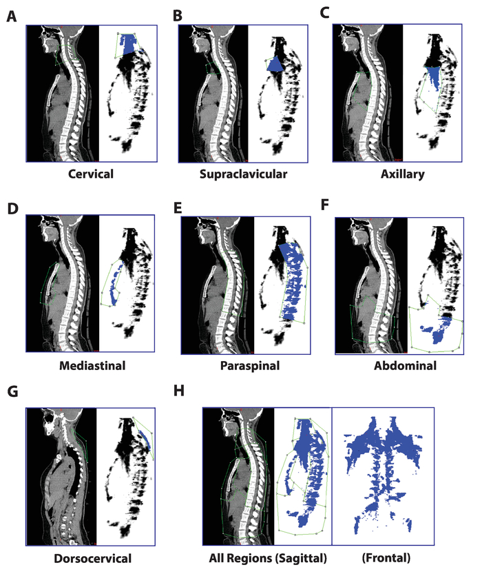 Associations of brown adipose tissue (BAT) 18 F-FDG activity after a