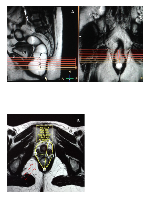 Quantification of Levator Ani Hiatus Enlargement by Magnetic Resonance  Imaging in Males and Females with Pelvic Organ Prolapse
