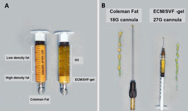 Purified fat transfer from 10 ml Luer Lock ® syringe to a 1 ml Luer
