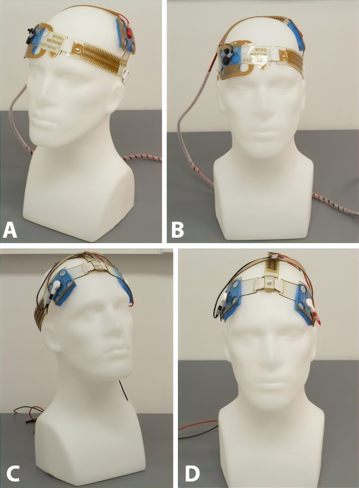 Updated Technique For Reliable, Easy, And Tolerated Transcranial ...